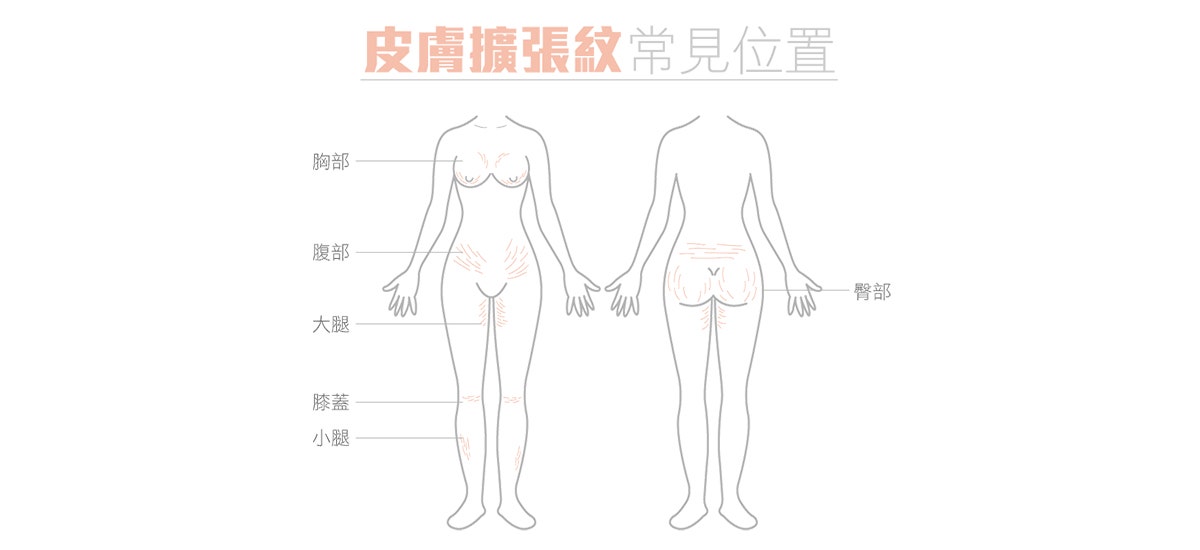 去除妊娠紋