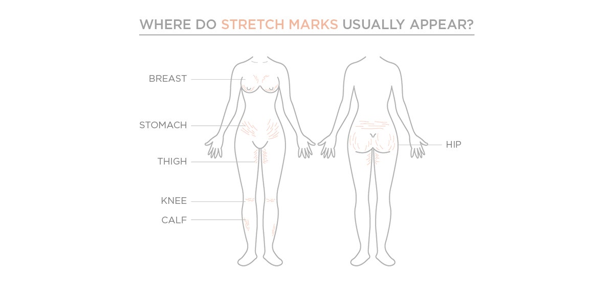 image showing areas for stretchmarks, prevent STRETCH MARK 